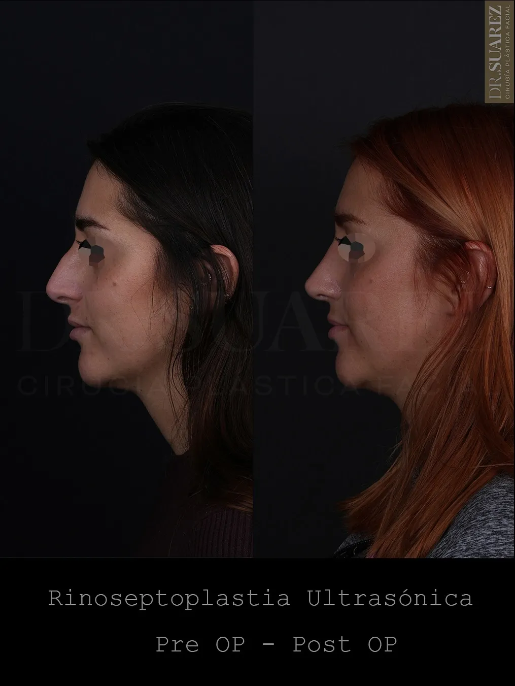 9-month rhinoplasty result After dissolving the existing filler, we performed a to create a smooth, natural dorsal line and…
