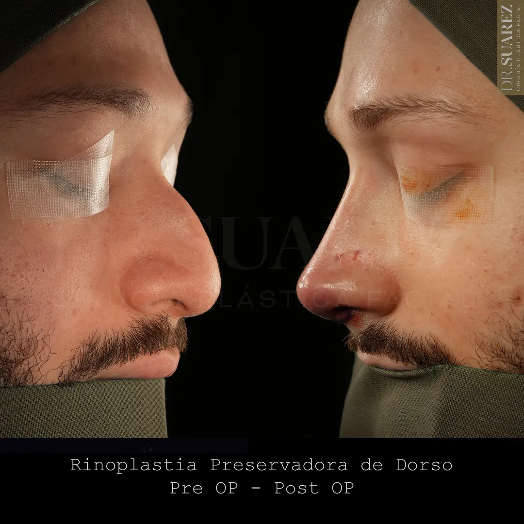 Caso de Rinoplastia Compleja: Piel Gruesa y Cartílago Débil Este caso de resultó ser relativamente complejo debido a la…